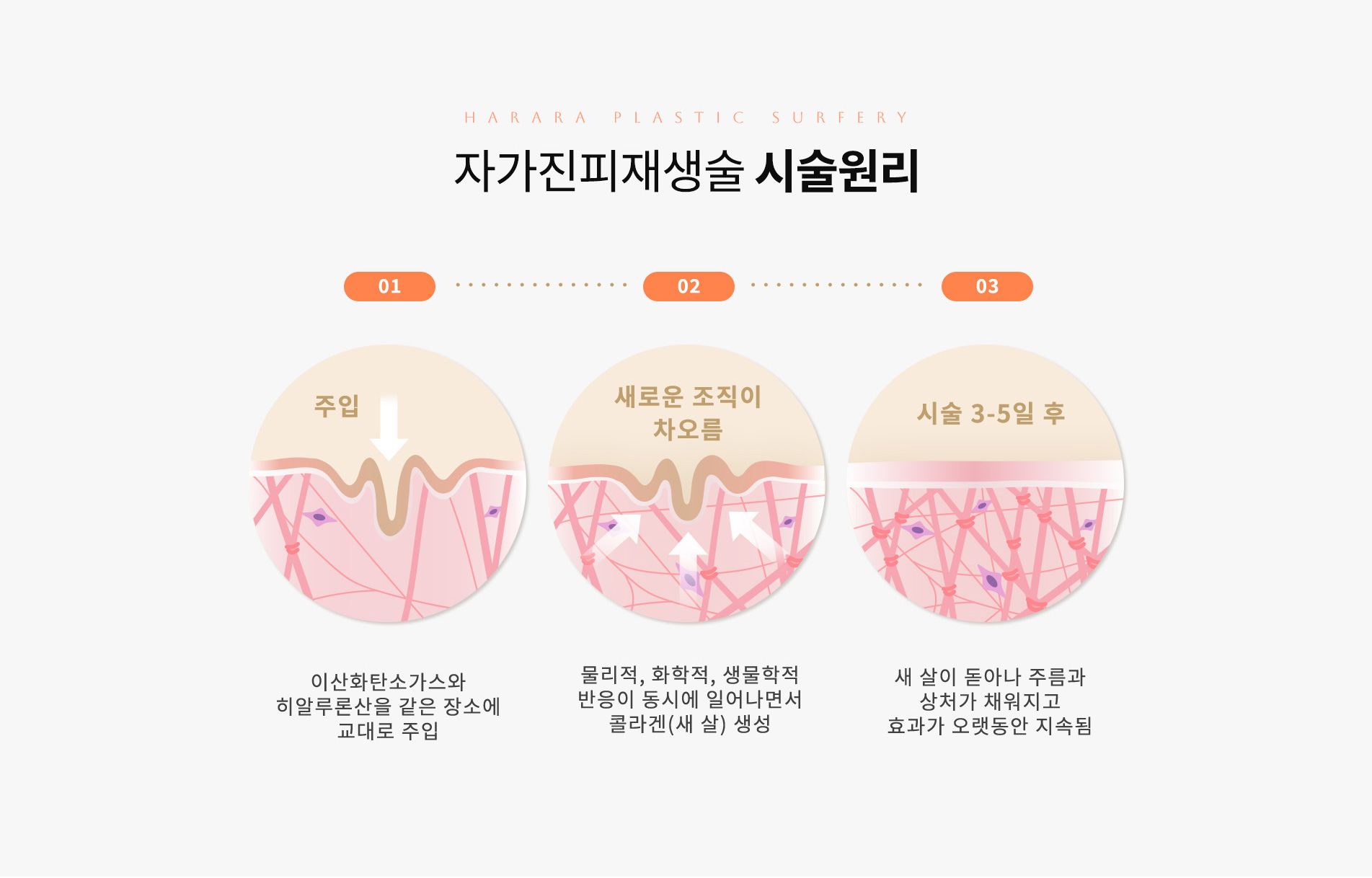 시술원리