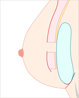 올바른 경로로 삽입