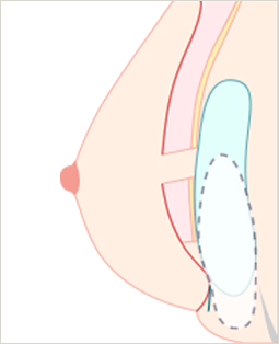 더블 버블 현상 발생